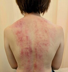 「筋膜はがし」2年4ヶ月振りに施術したら・・・　ロータリー院